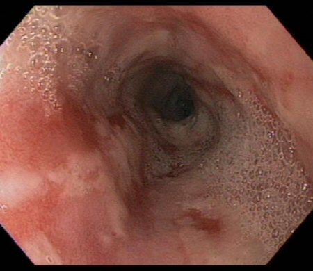 Assessment of upper gastrointestinal bleeding images