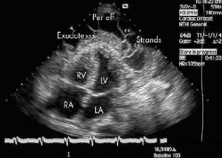 Assessment of pericardial effusion images