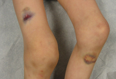 Haemophilia images