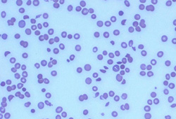 Hemolytic uremic syndrome images