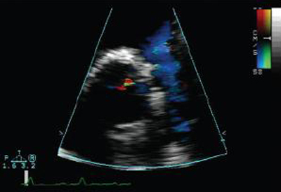 Pulmonary regurgitation images