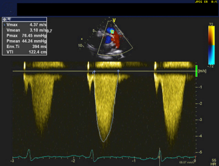 Pulmonary stenosis images