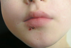 Impetigo images