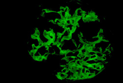 Anti-glomerular basement membrane (Goodpasture's) disease images