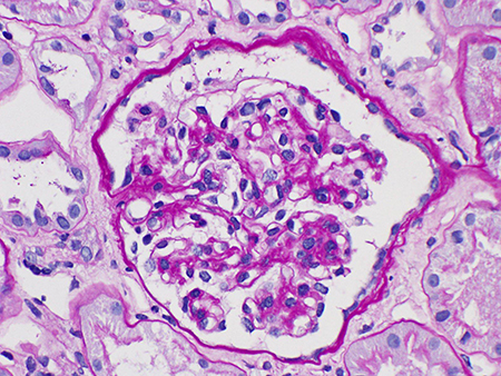 IgA nephropathy images