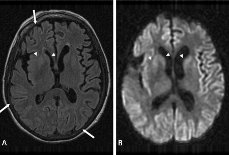 Prion disease images