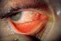 Assessment of red eye images