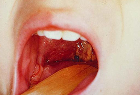 Acute pharyngitis images