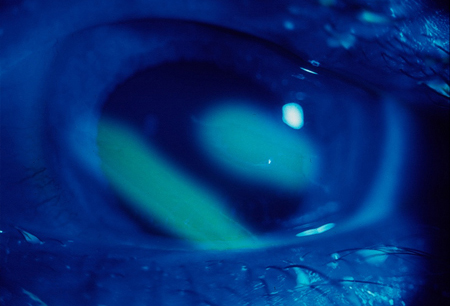 Corneal abrasions images