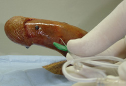 Priapism images