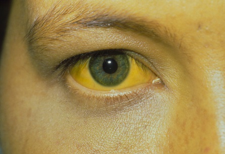 Evaluation of jaundice images