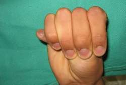 Marfan syndrome images
