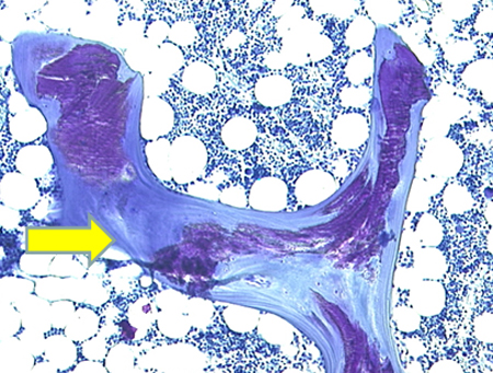 Osteomalacia images