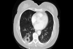Vasculite sistêmica images
