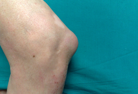 Bursitis images