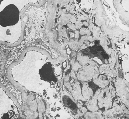 Diabetic kidney disease images