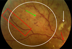 Diabetic retinopathy images
