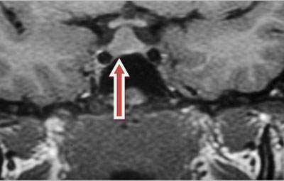 Assessment of hyperprolactinaemia images