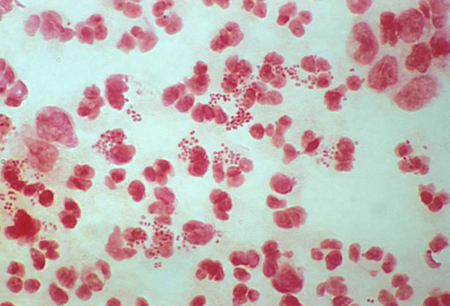 Uretrite images