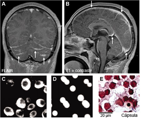 Meningite fúngica images