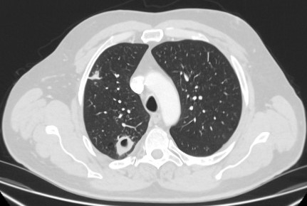 Avaliação de nódulo pulmonar solitário images