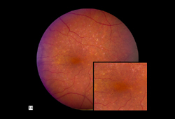 Degeneração macular relacionada à idade images