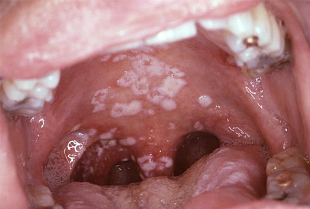 HIV in adults images