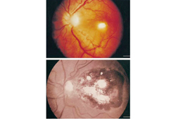 Toxoplasmosis images