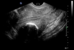 Miomas uterinos images