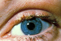 Blepharitis images