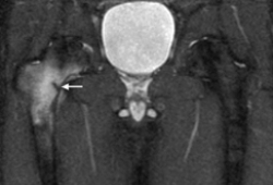 Groin pain images