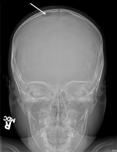 Langerhans cell histiocytosis images