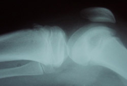 Doença de Osgood-Schlatter images