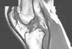 Lesão do ligamento cruzado anterior images