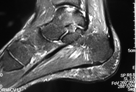 Osteochondritis dissecans images