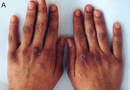 Dermatomyositis images
