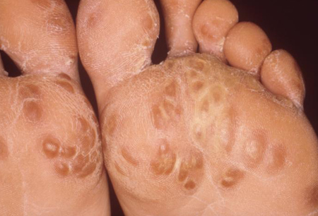 Reactive arthritis images