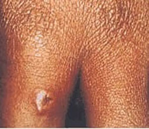 Anthrax images