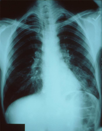 Infecção por Chlamydia pneumoniae images