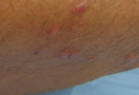 Poison ivy, oak, and sumac images