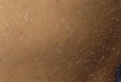 Miliaria images