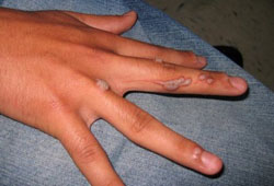 Common warts images