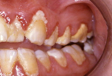 Gingivitis images