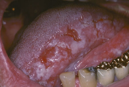 Oral leukoplakia images