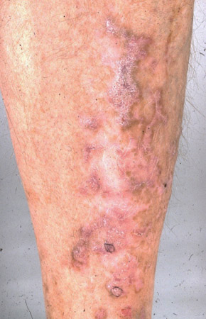 com.bmj.content.model.Caption@398aef5e