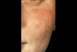 Polymorphous light eruption images