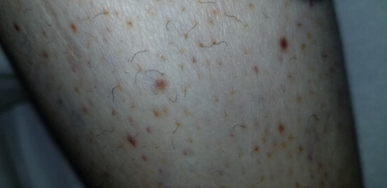 Vitamin C deficiency images