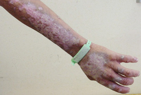 Vitamin B3 deficiency images