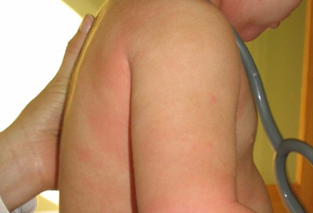 Alergia alimentar images