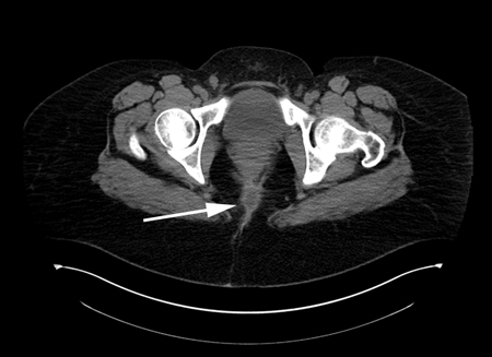 Abscesso anorretal images